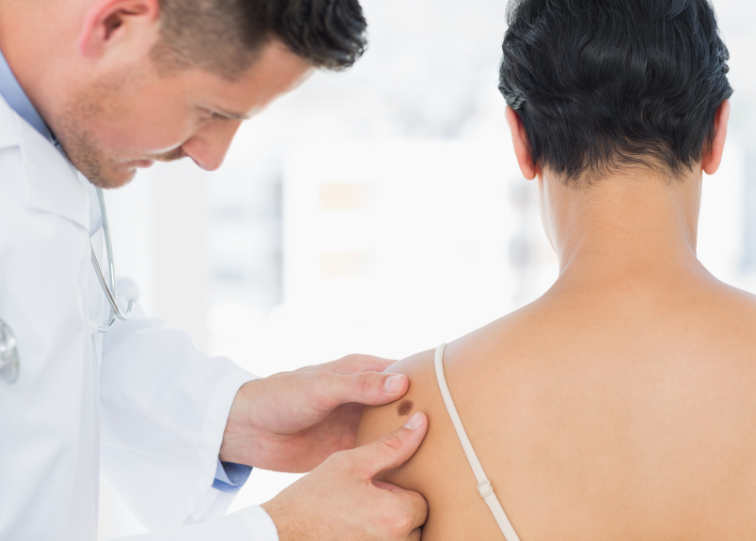 Doctor examining mole