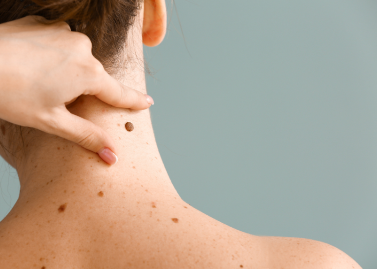 Types of moles cheap