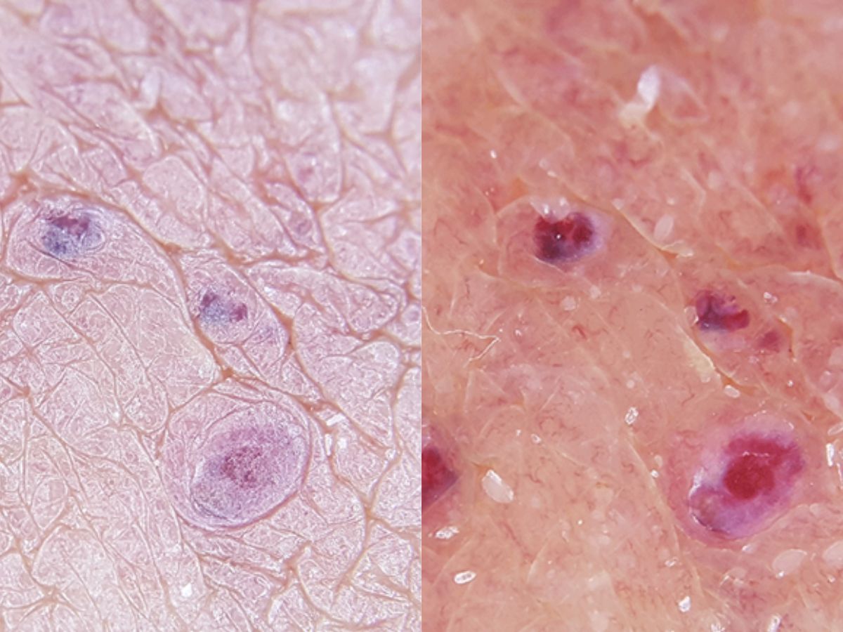 angiokeratoma with dermatoscope
