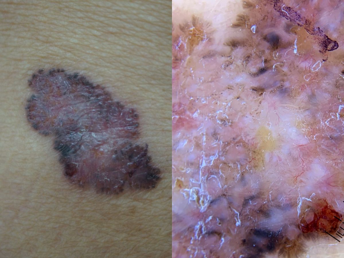 Basal Cell carcinoma with dermatoscope