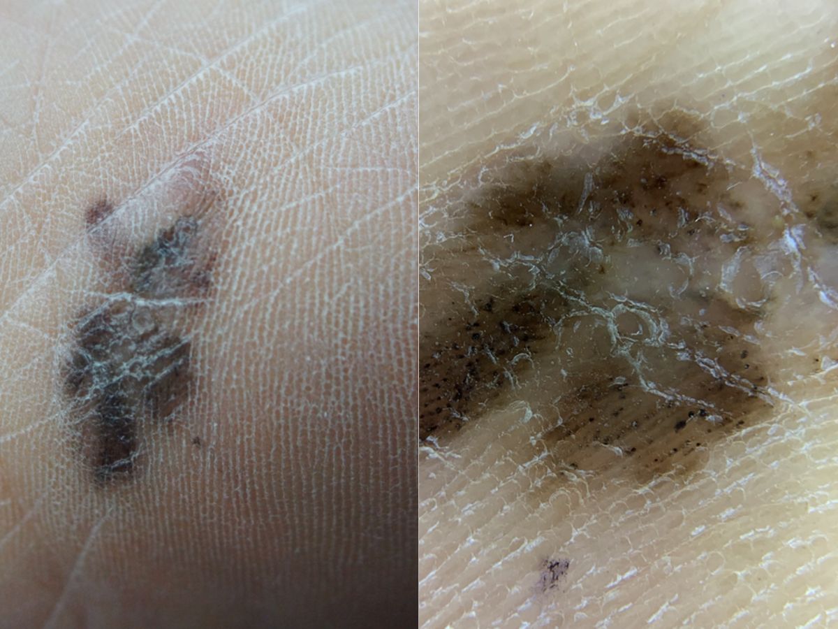 malignant melanoma with dermatoscope