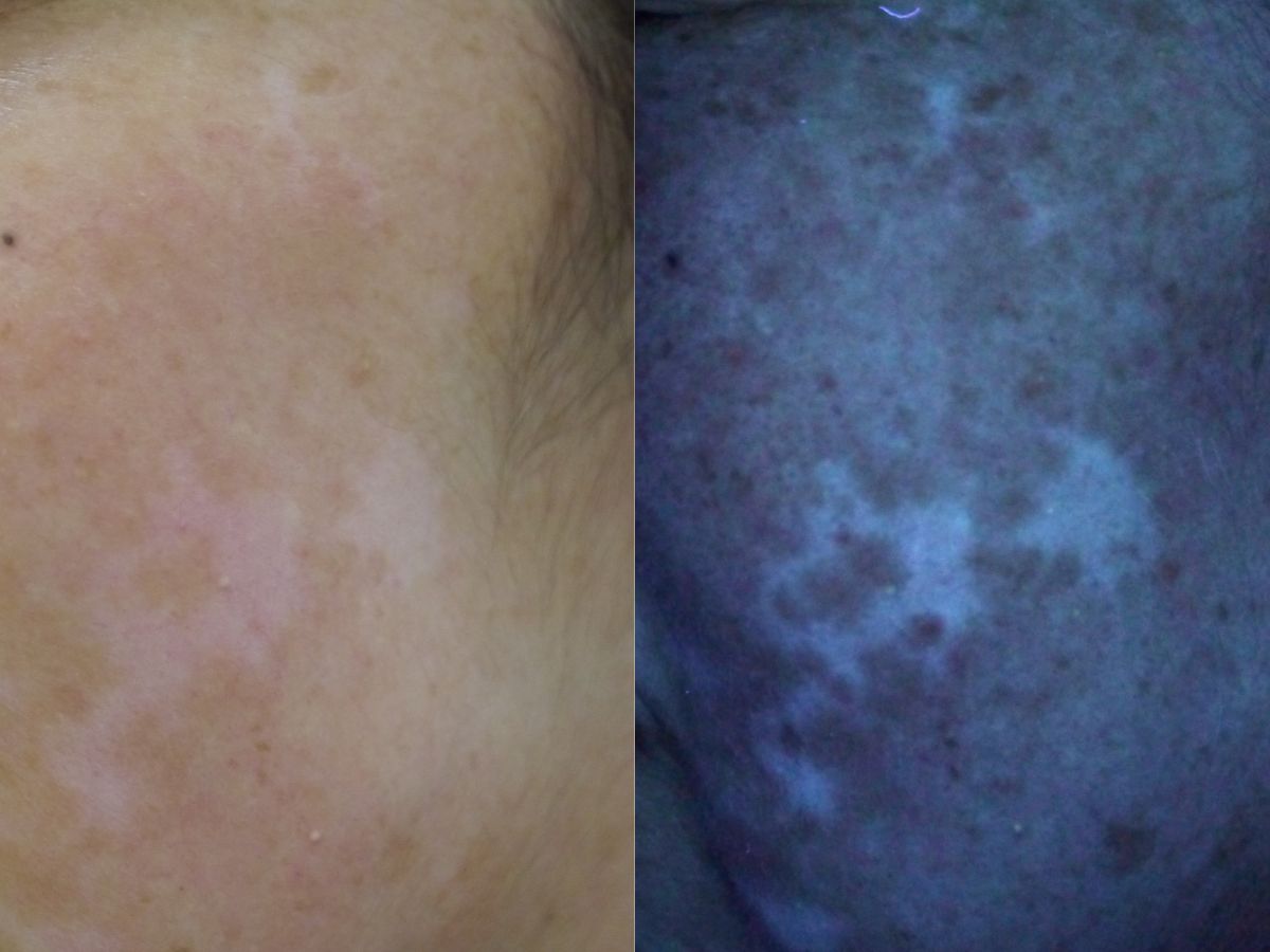 Vitiligo with woods lamp