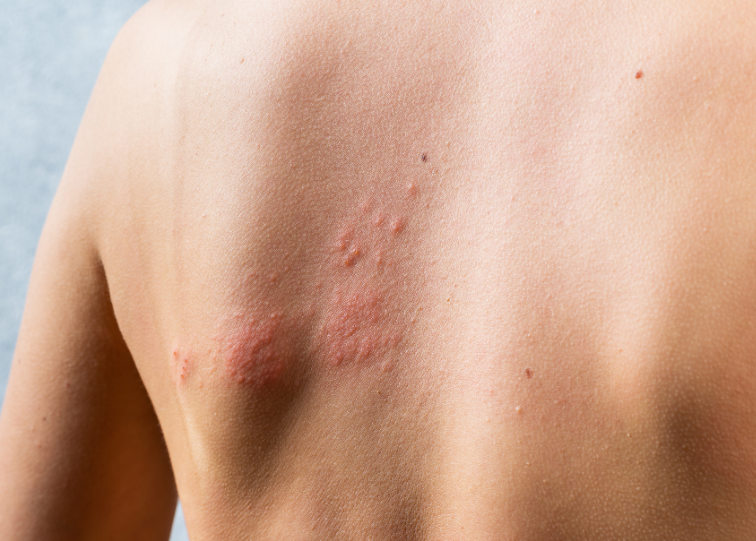 Exploring Skin Lesions: Definition and Types