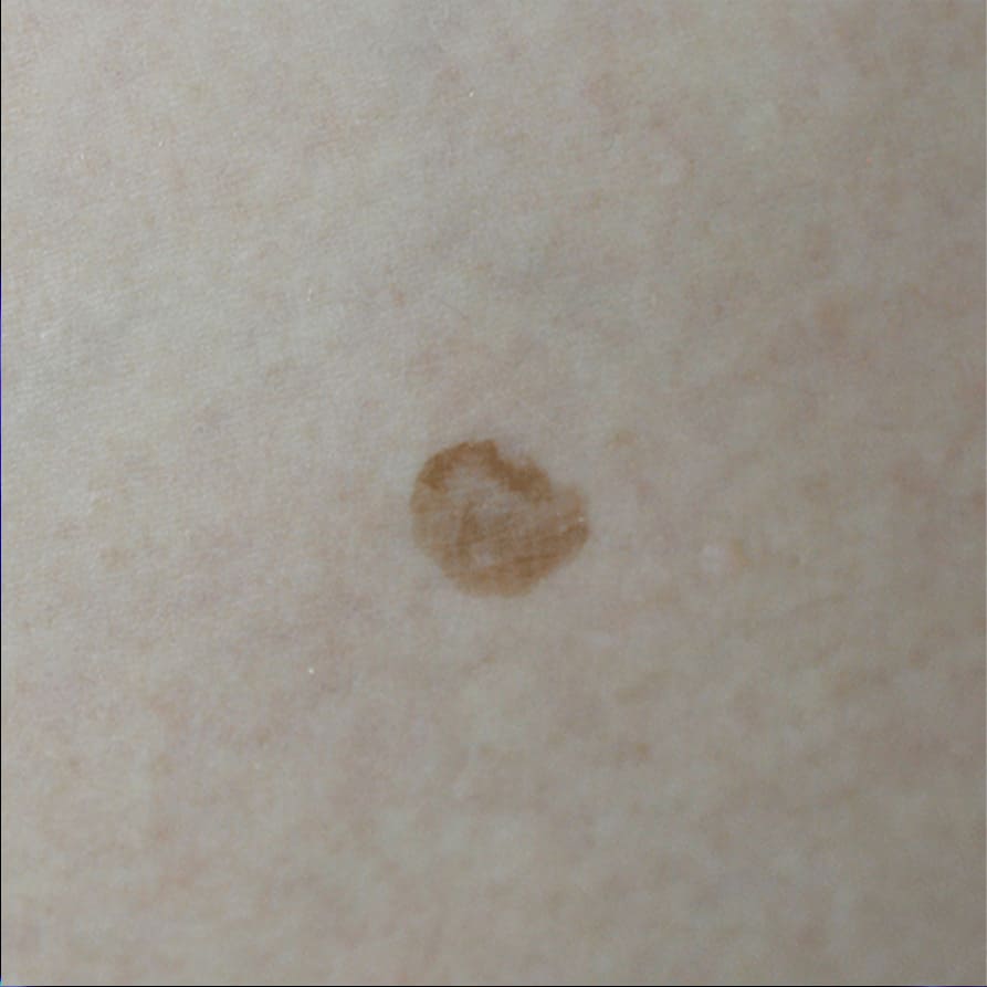 Naked-eye view of seborrheic keratosis showing a brown lesion and surrounding skin