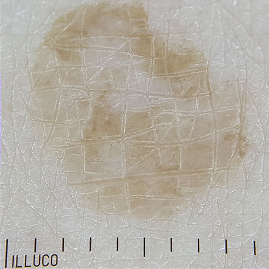 Non-polarized dermoscopic view of seborrheic keratosis with the ILLUCO IDS-1100, showing surface texture and skin markings