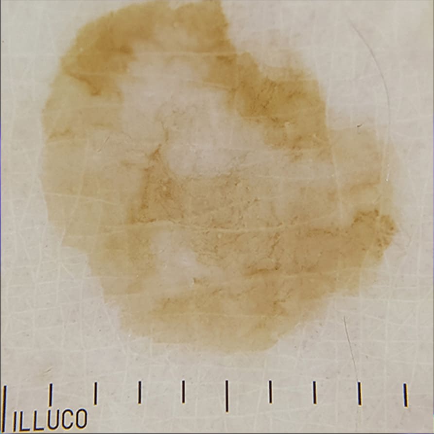 Polarized dermoscopic view of seborrheic keratosis with the ILLUCO IDS-1100, showing variations in brown pigmentation