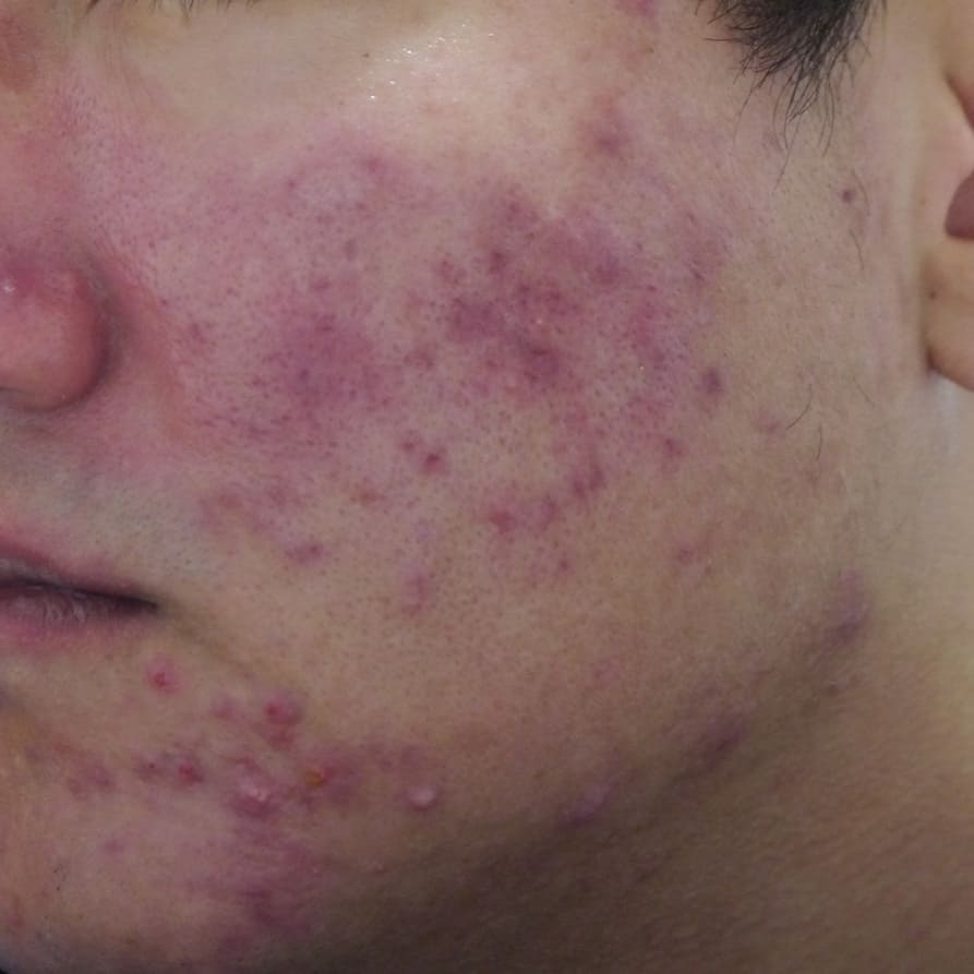 Non-polarized IDS-3100 image of facial acne, showing redness and raised spots across the cheek and chin