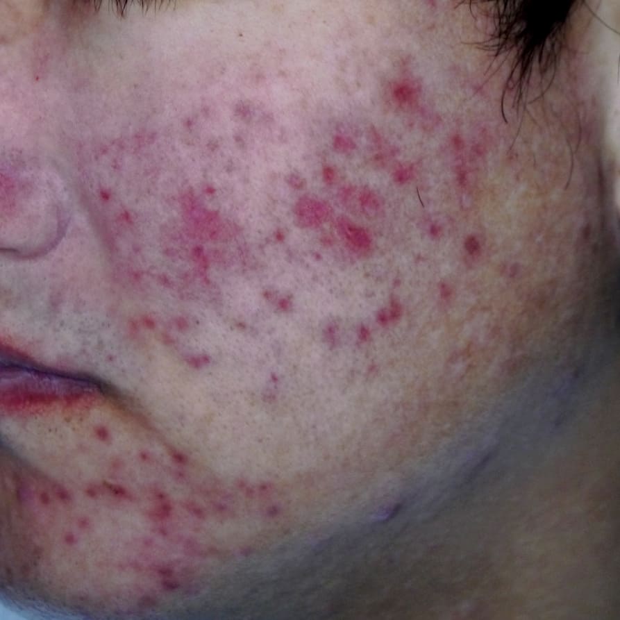 Polarized IDS-3100 image of the same acne-affected cheek and chin, showing variations in redness