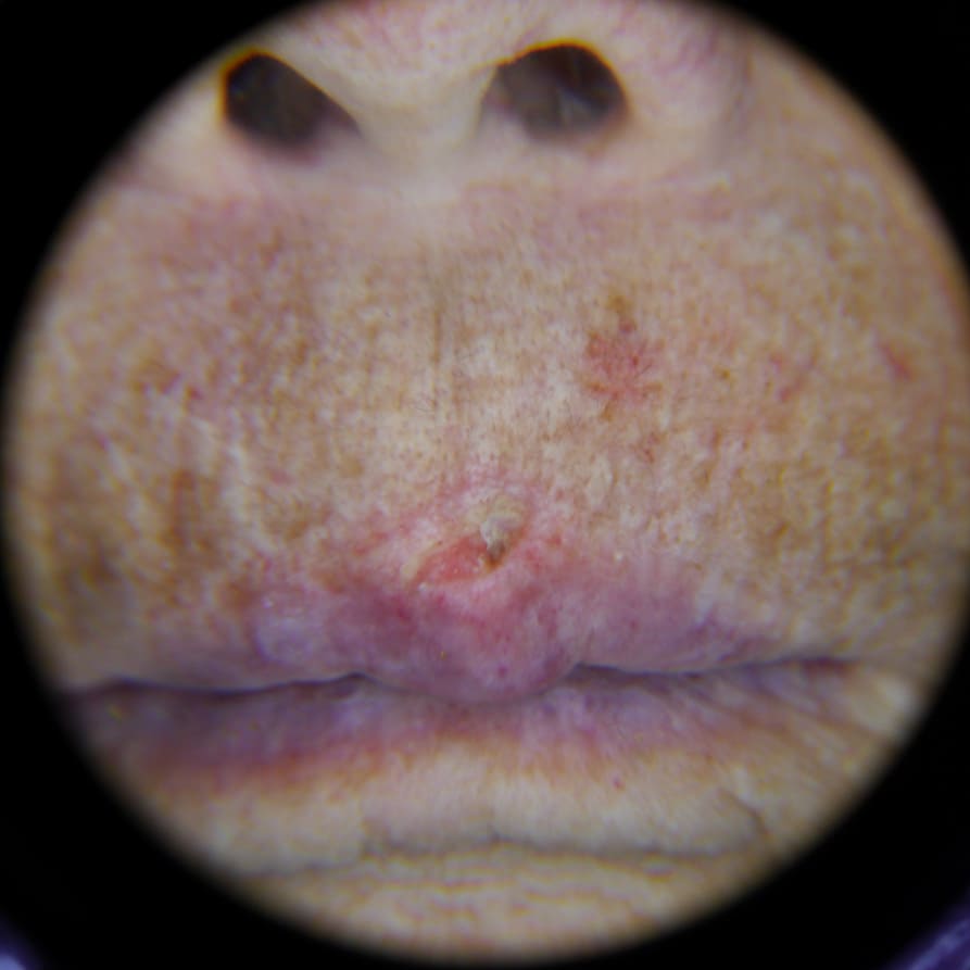 Polarized IDS-3100 view of a documented skin cancer lesion above the upper lip