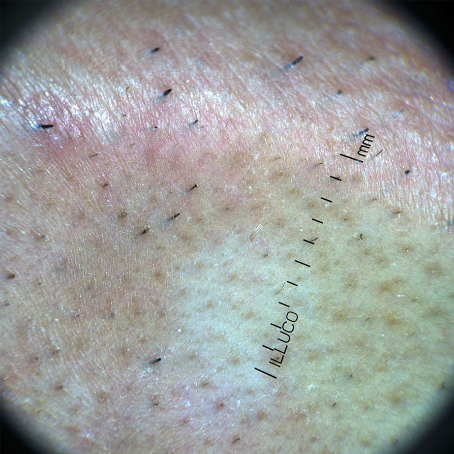 9100 dermatoscope showing parallel polarization