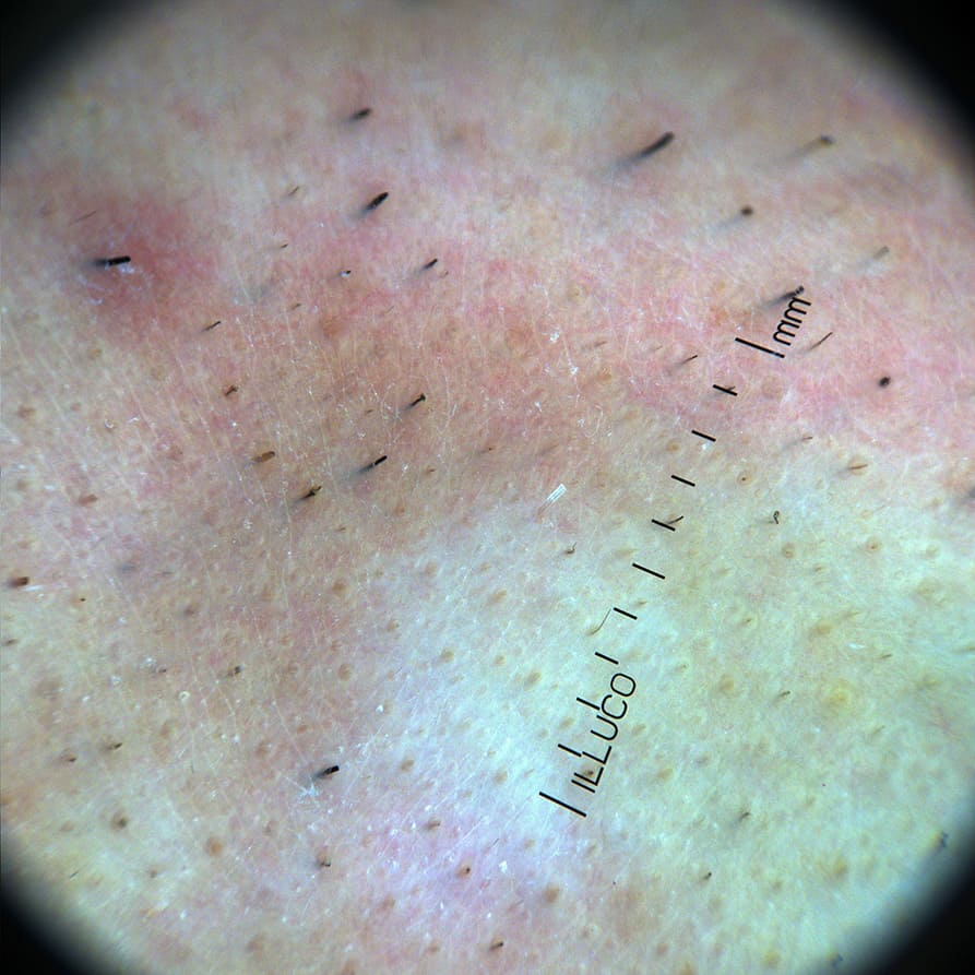 9100 dermatoscope showing cross polarization