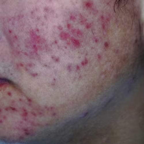 blemish or lesion shown from a dermatoscope