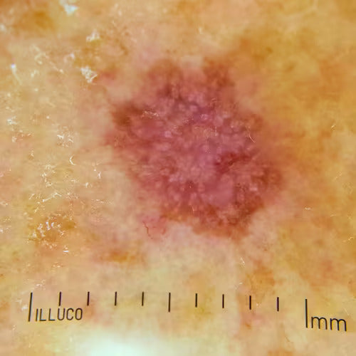 blemish or lesion shown from a dermatoscope