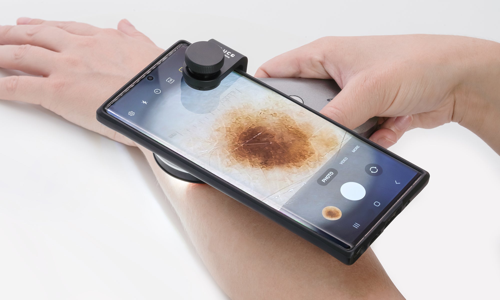 mole with dermatoscope