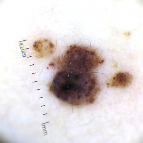 blemish or lesion shown from a dermatoscope