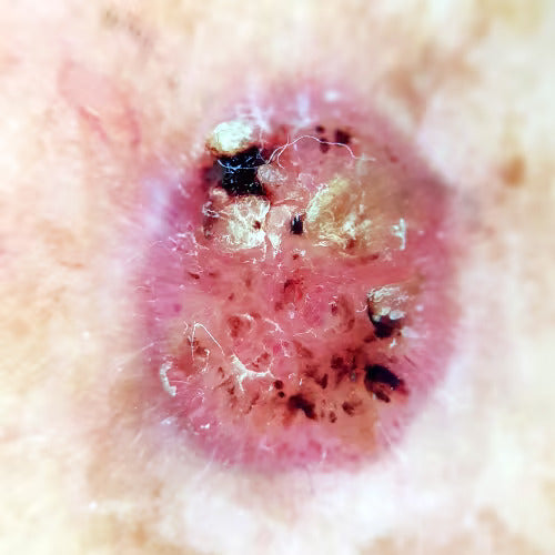 blemish or lesion shown from a dermatoscope
