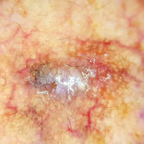 blemish or lesion shown from a dermatoscope