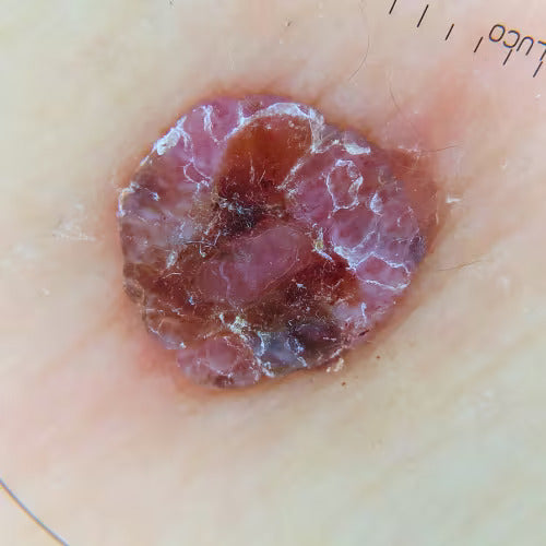 blemish or lesion shown from a dermatoscope