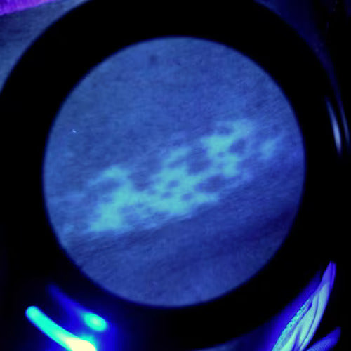 blemish or lesion shown from a dermatoscope