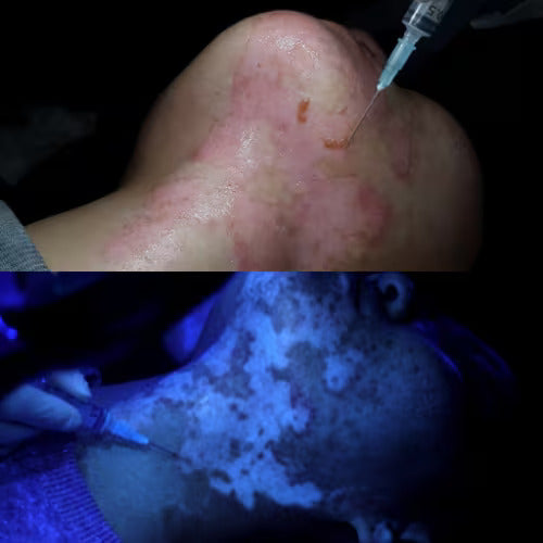 blemish or lesion shown from a dermatoscope