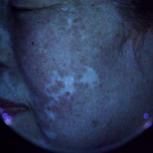 blemish or lesion shown from a dermatoscope